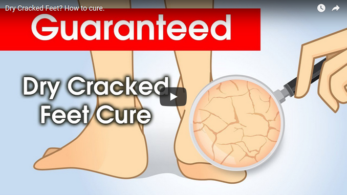 cracked feet cure
